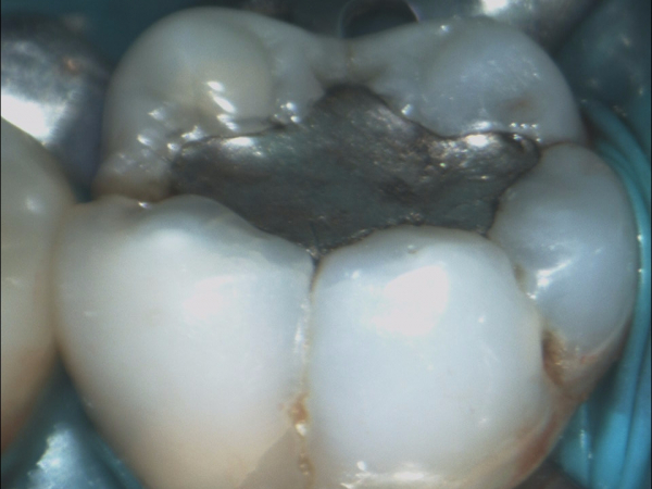 36 EXTENSIVE CARIES AND INFLAMED LESION ON THE LOWER FIRST MOLAR WITH SUBSEQUENT TREATMENT